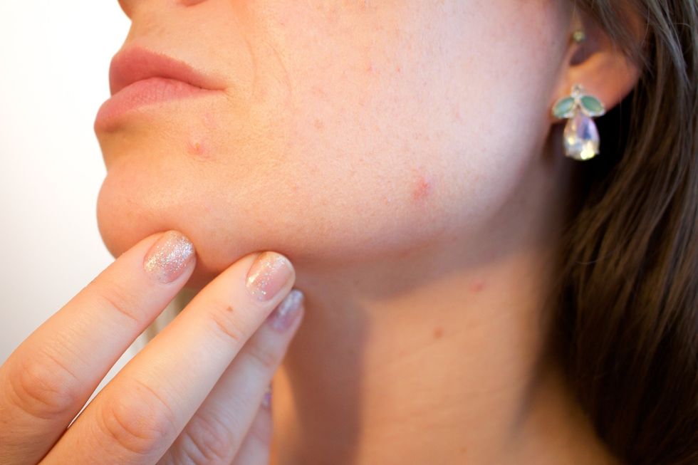 9 Things I Learned While Suffering From Acne