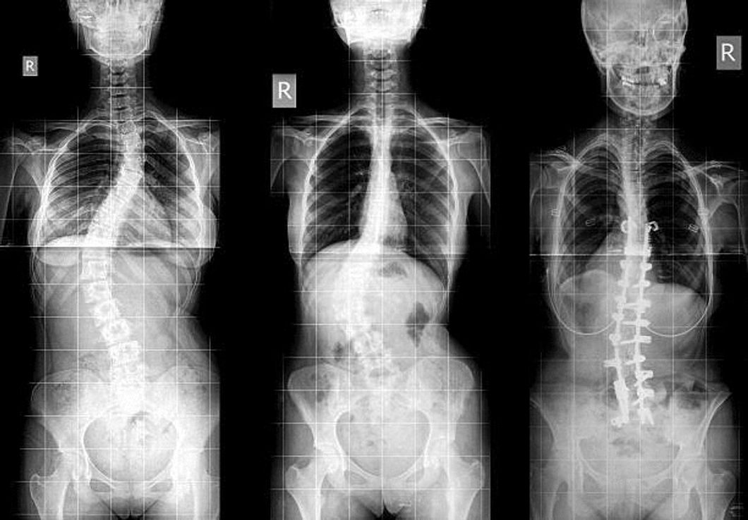 Scoliosis And Spinal Surgery Changed My Life In Tough And Surprisingly Beneficial Ways