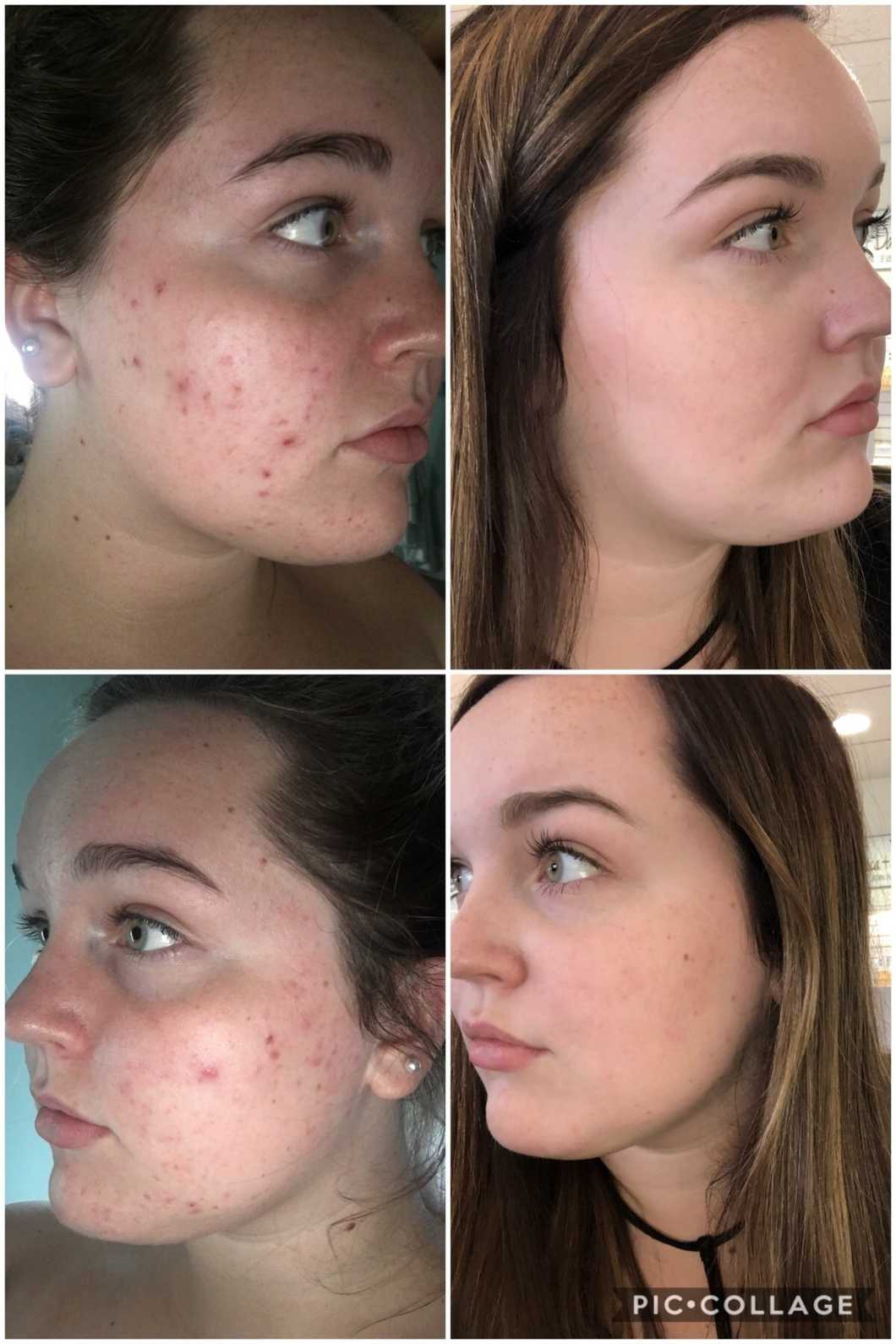 How I Transformed My Skin
