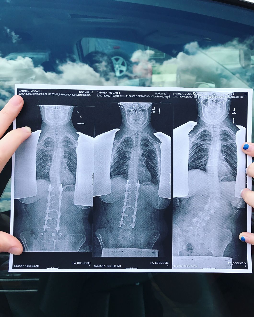 13 Life Lessons I Learned From 'Mofo' And 'Lil' S***,' The Two Metal Rods In My Spine
