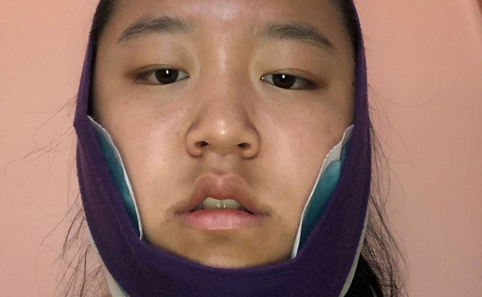 Everything I Did After Oral Surgery