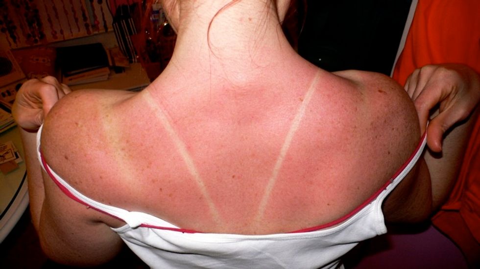 What It's Like Being A Pale Girl During Summer