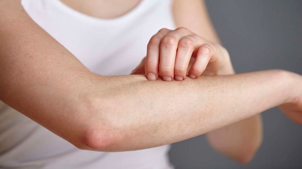 How To Make Bug Bites Stop Itching Fast!