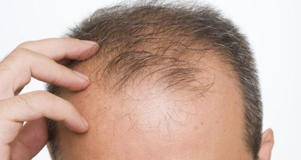 How Hair Transplant Can Change Your Appearance?