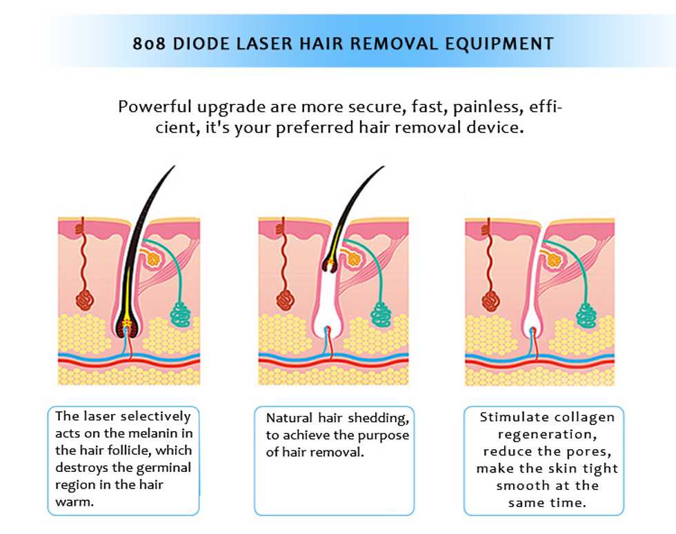 Why Should You Choose Laser Hair Removal?