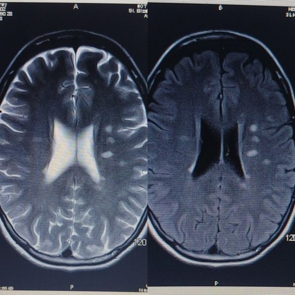 I have Multiple Sclerosis.