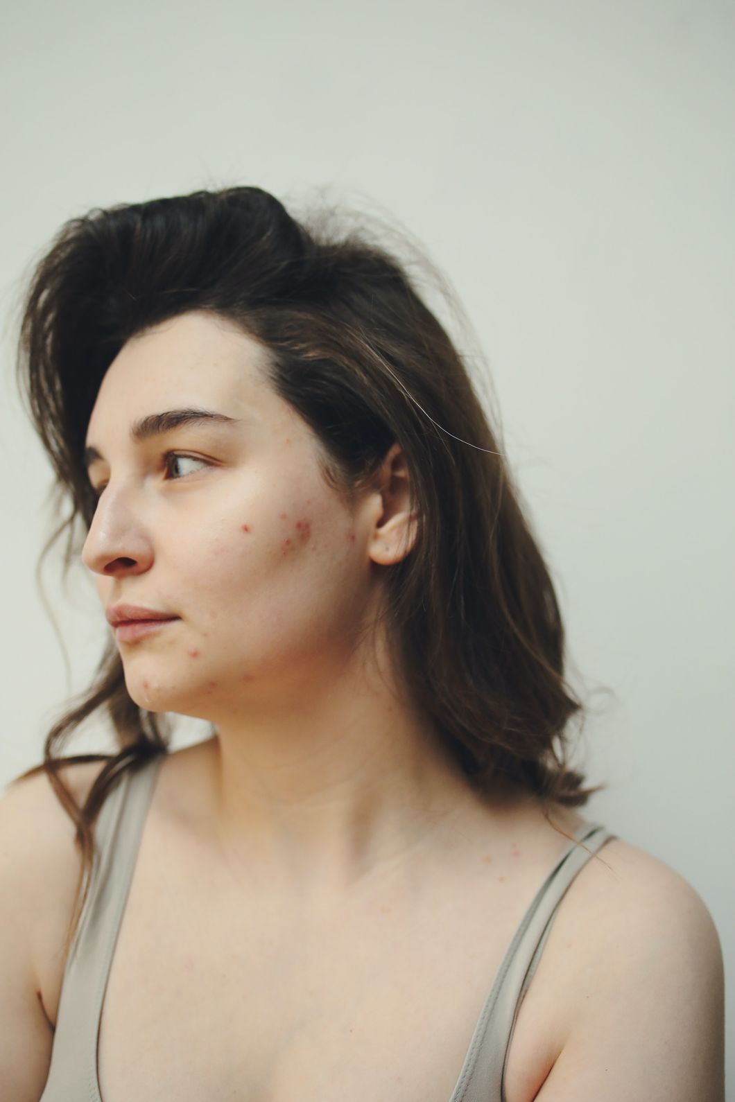 I've Struggled With Acne My Whole Life, And I'm Finally Learning To Embrace It