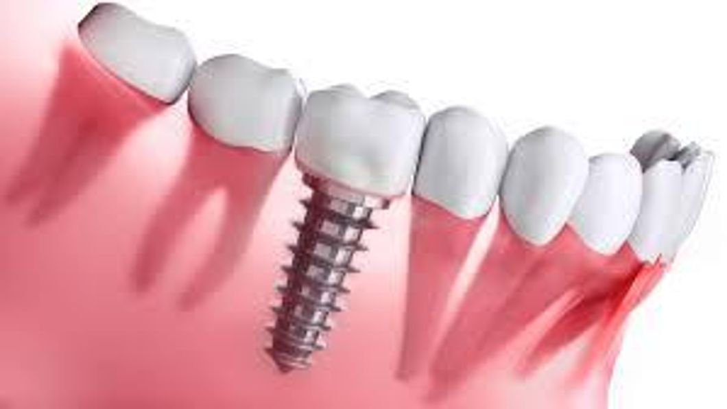 What You Can Do to Prepare for Your First Dental Implant