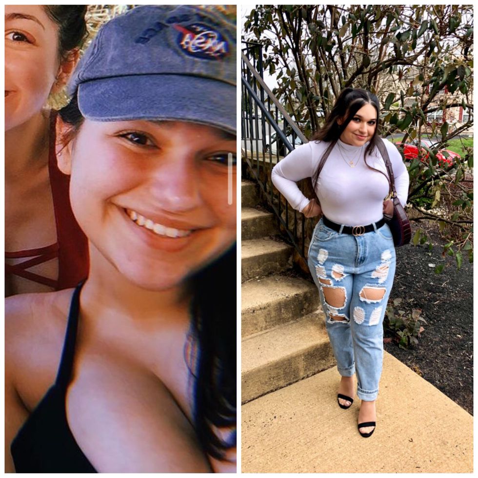 Breast Reduction Reality: Is It Worth It?