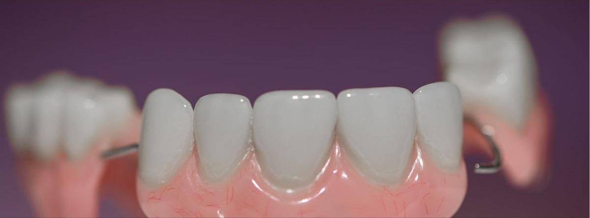 Dental Crowns: A Complete Guide