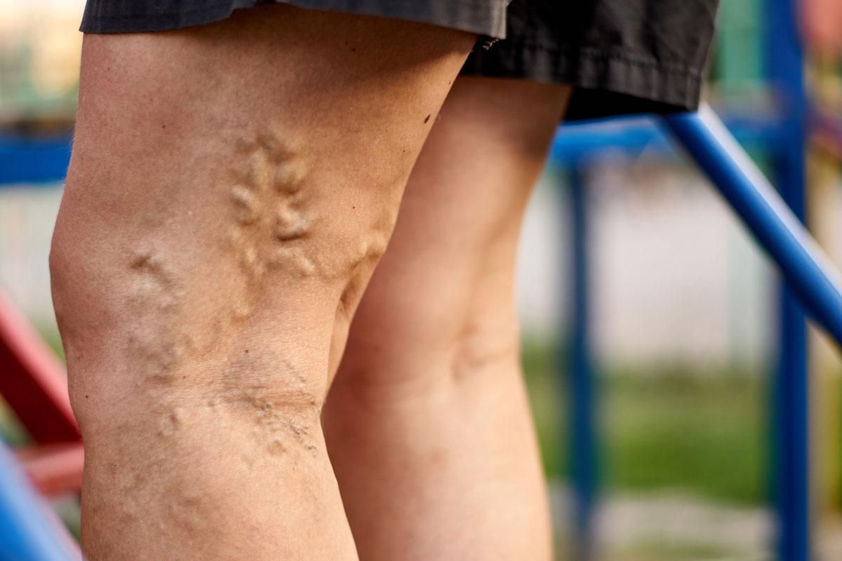What Are The Benefits of Varicose Vein Treatment Boise?