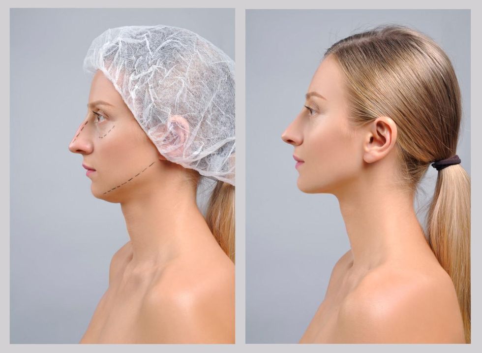 Rhinoplasty Costs in the United Kingdom and Abroad