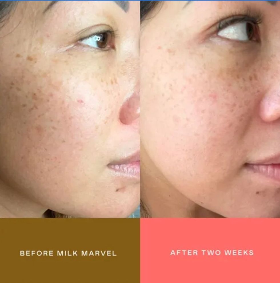 How effective is brightening serum for dark spots on the face?
