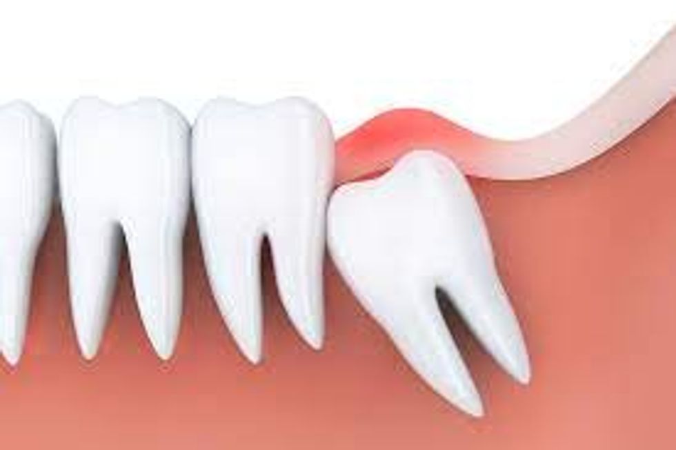 Healthy benefits of removing your wisdom teeth