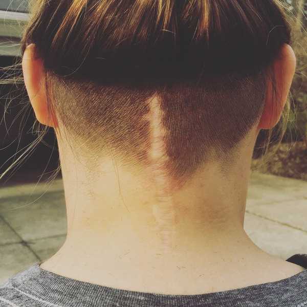 Learning To Love Your Scars