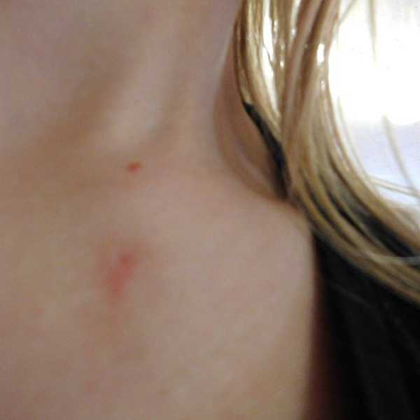 Living With A Branchial Cleft Cyst