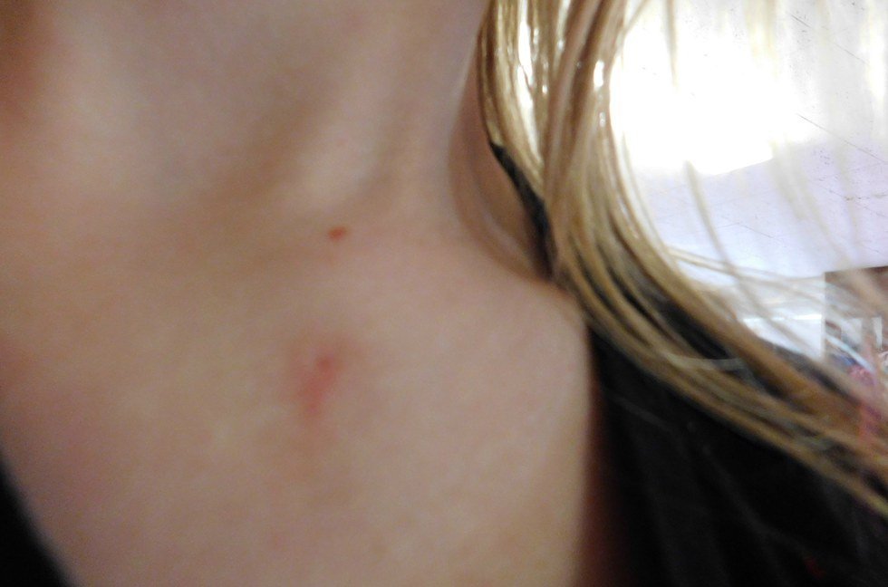 Living With A Branchial Cleft Cyst | The Odyssey Online