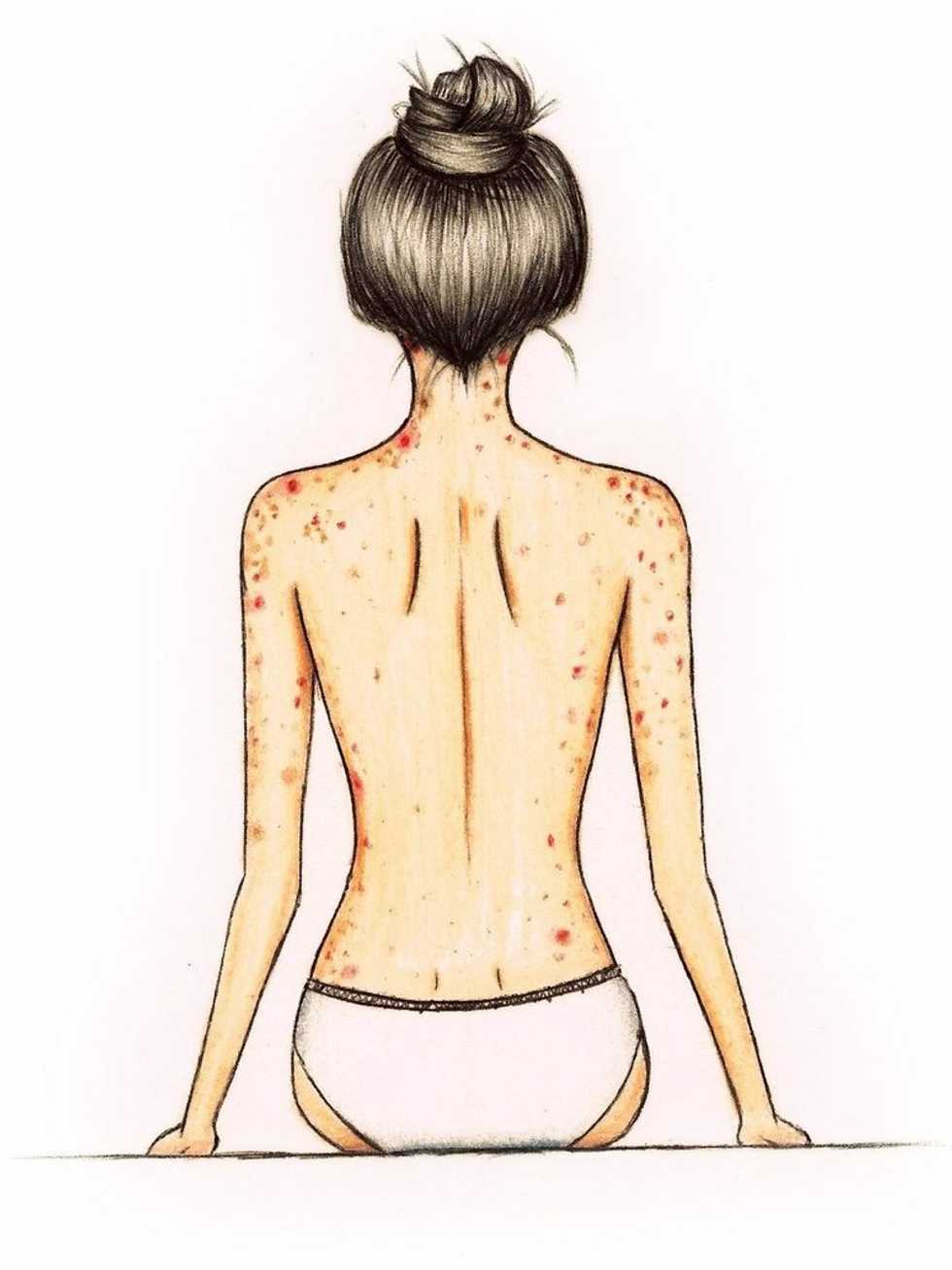 Skin-Picking Disorder