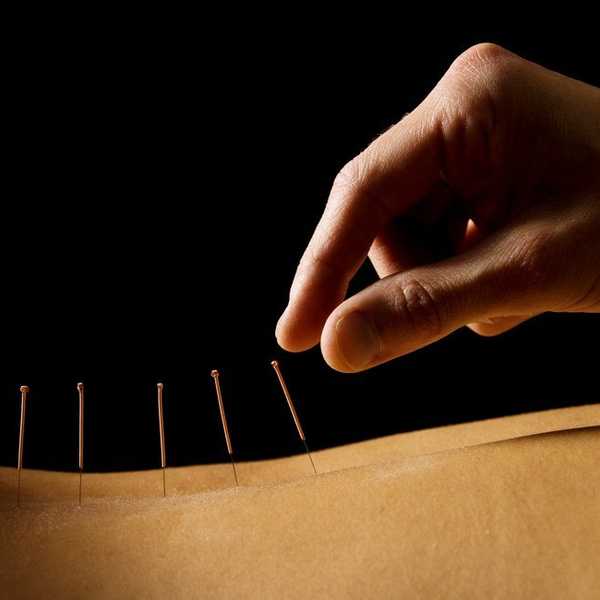 Acupuncture Is The Best Answer You've Been Looking For
