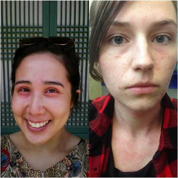 To The Eczematic Youth, I See Your Face