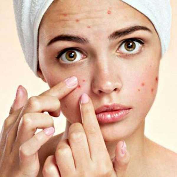 Why I'm Not Ashamed Of My Acne