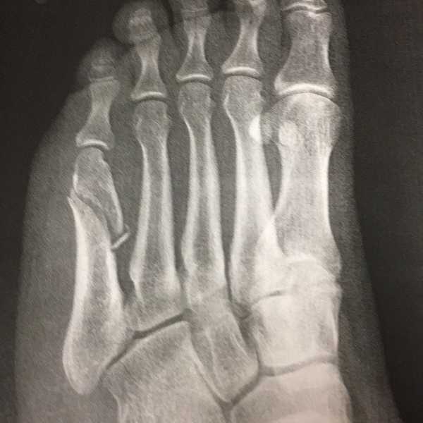 I Broke My Foot, And What I Learned From It Surprised Me
