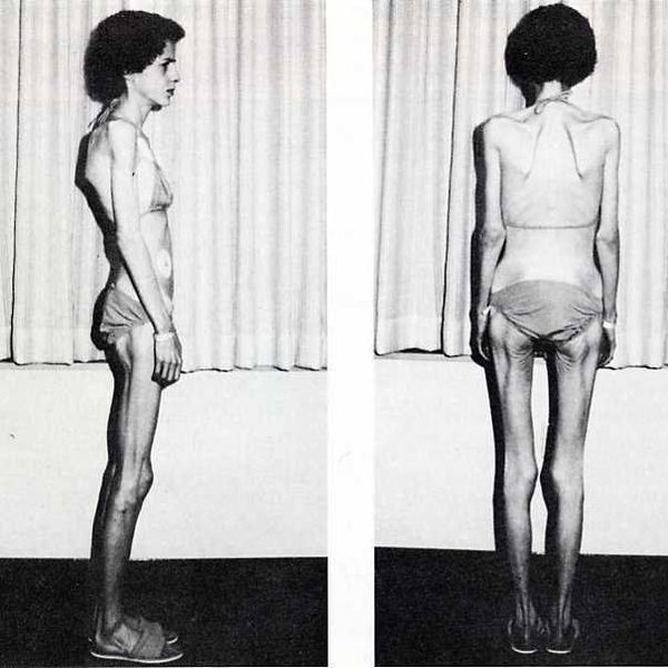 Anorexia Nervosa