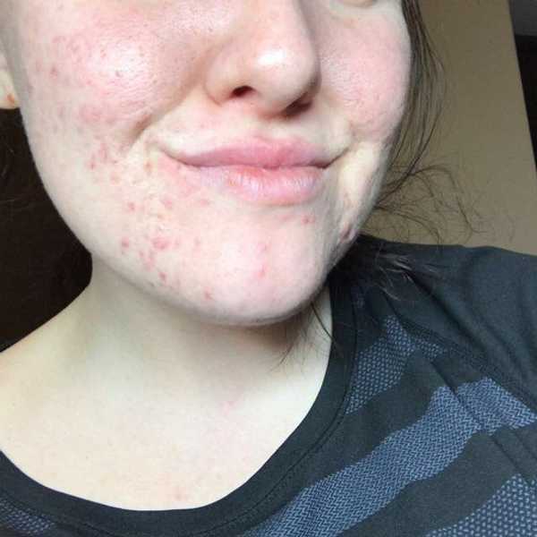 Embrace Your Blemishes