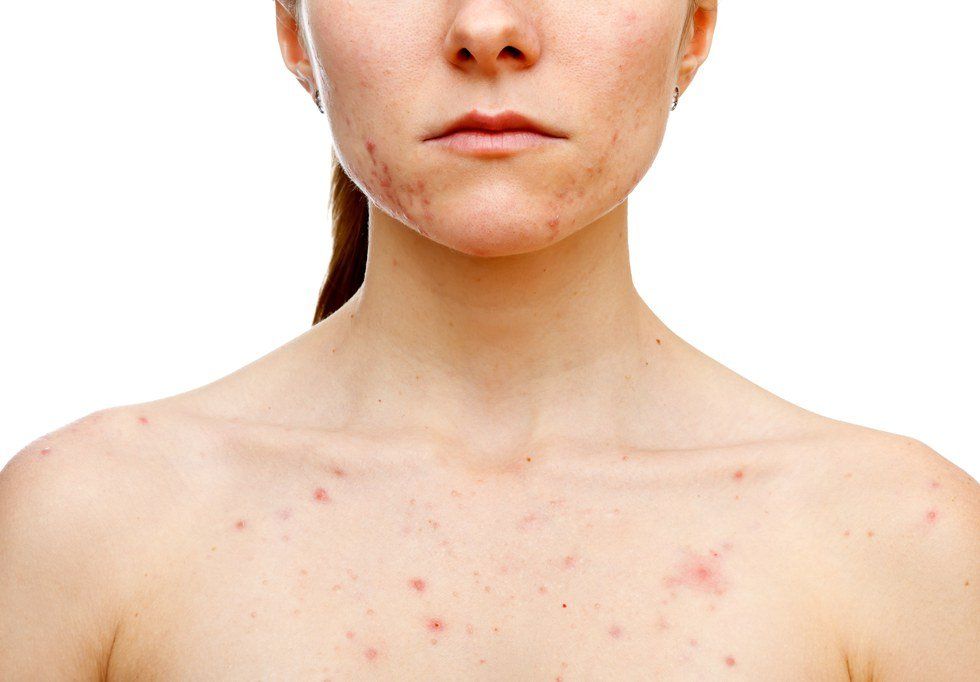 Things People Don't Understand About Acne