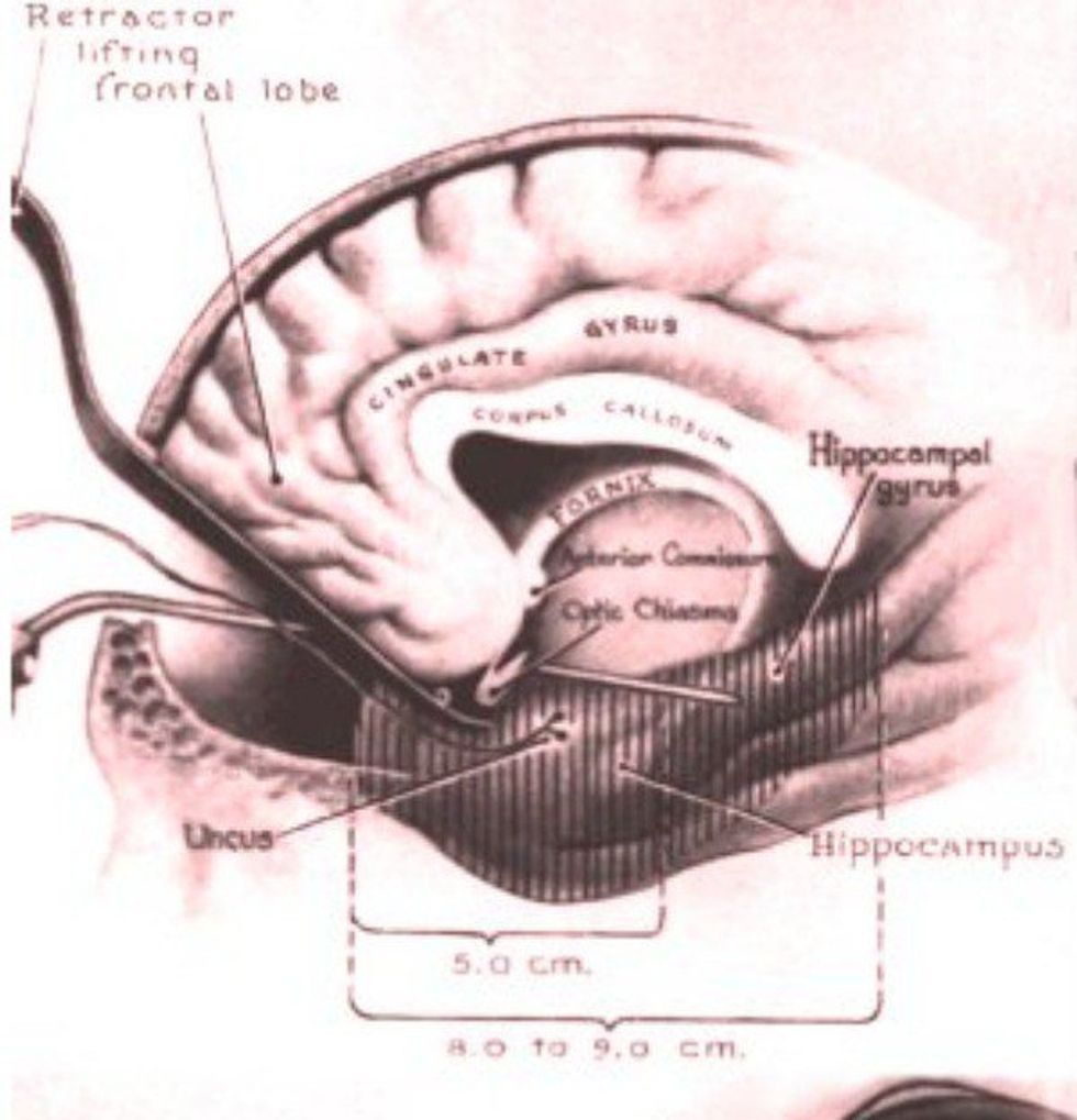 H.M.'s Contribution to Memory