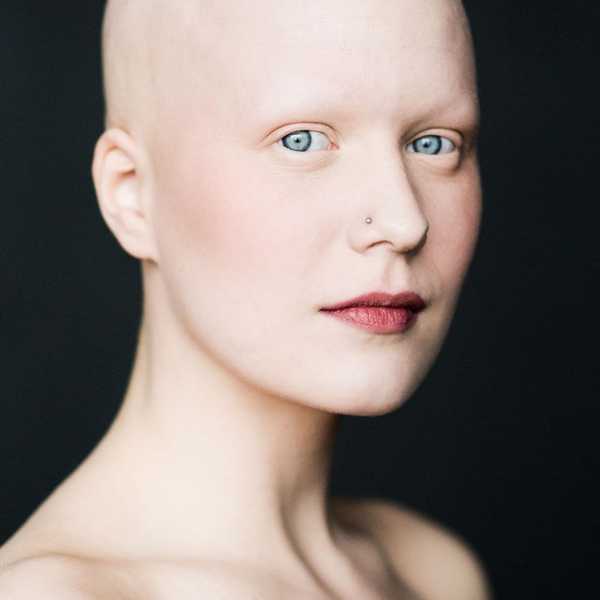 5 Things Someone With Alopecia Want You to Know