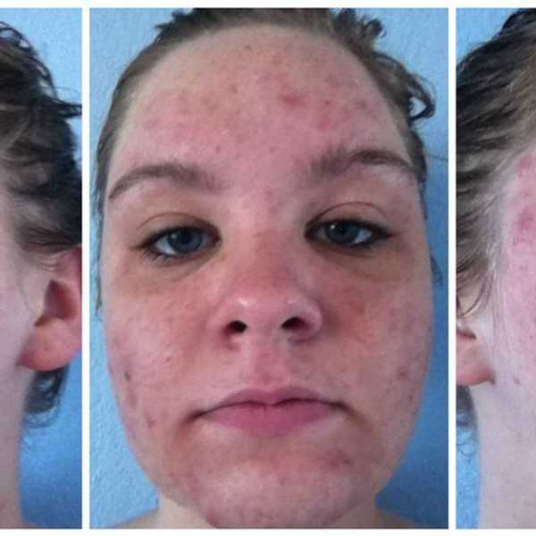 What I Learned From Being a Pimple-Face