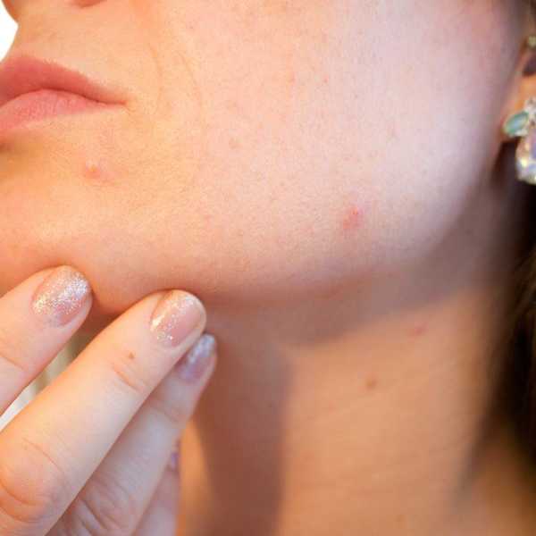 7 Reasons I'm Thankful I Had Acne