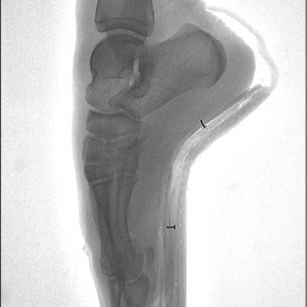 Ballet and Broken Bones