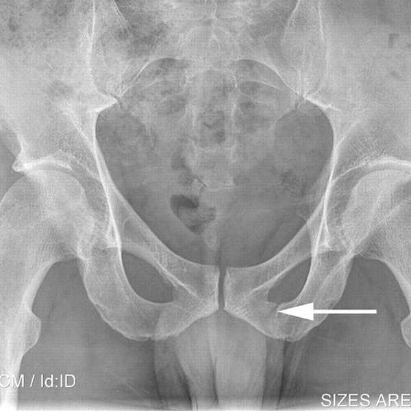 How I Survived A Pelvic Stress Fracture