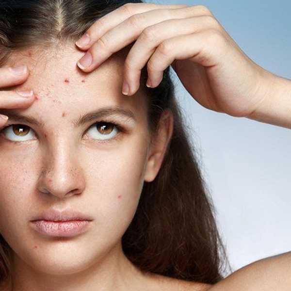 5 Best Foundations for People with Acne-Prone Skin