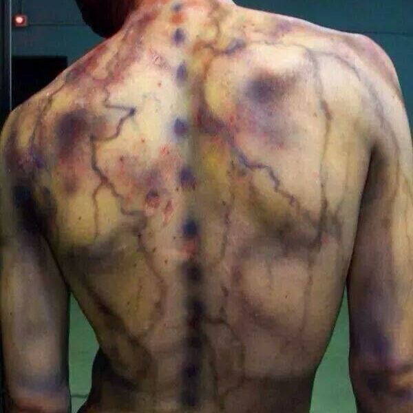 Fibromyalgia: The Truth Behind The Pain