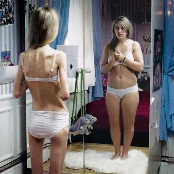 A Skinny Girl With Body Dysmorphia