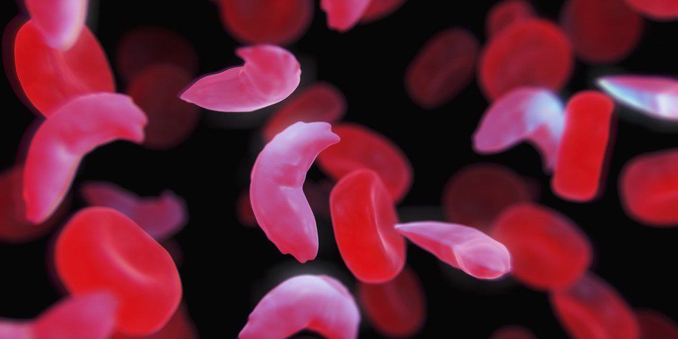 What You Should Know About Sickle Cell Disease