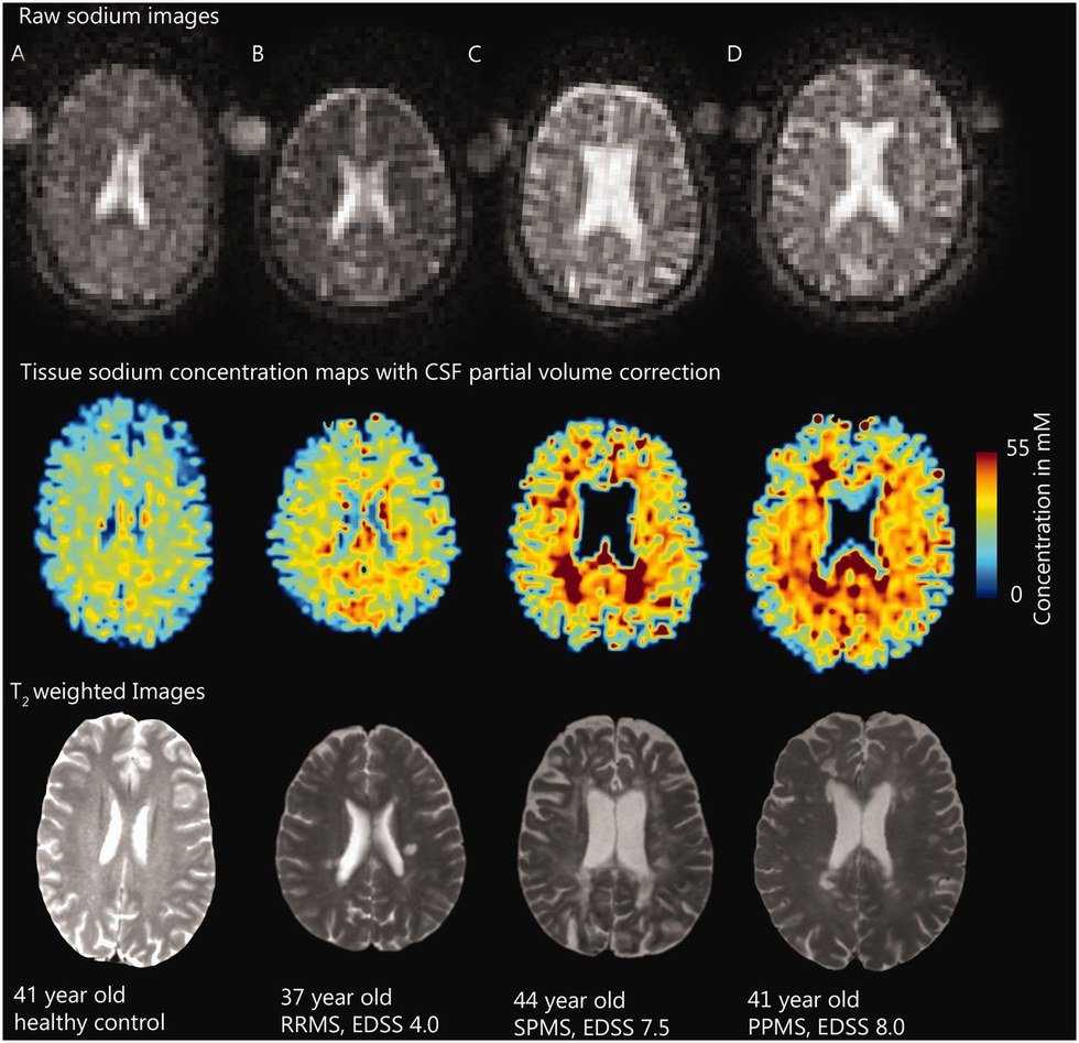 My Struggles With Concussion