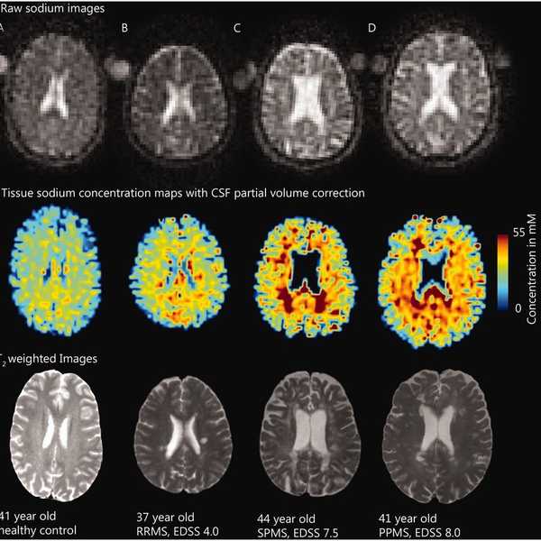 My Struggles With Concussion