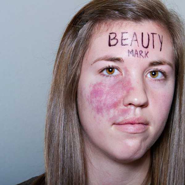 Birthmarks Are Like Barcodes