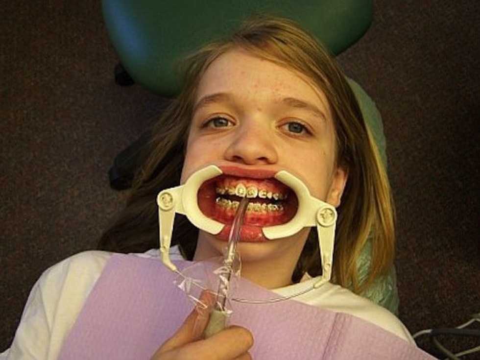 The Awkwardness Of Braces In College | The Odyssey Online