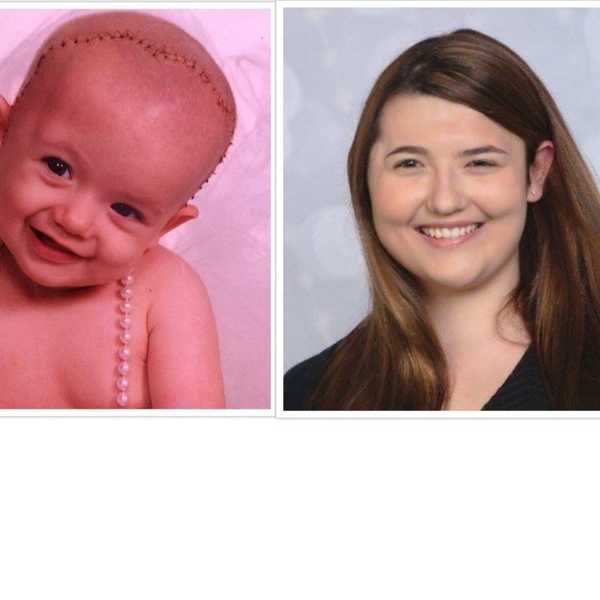 What Is Craniosynostosis?