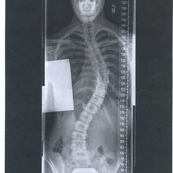 Let's Get this Straight: Scoliosis Surgery
