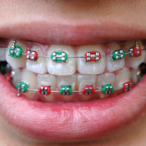 13 Things People Who Had Braces Remember