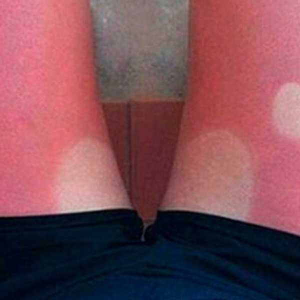 Thoughts Of A Pale Person Trying To Tan But Burning… Horribly