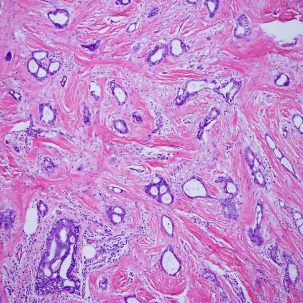 Mammograms: Saving The Lives Of Your Loved Ones