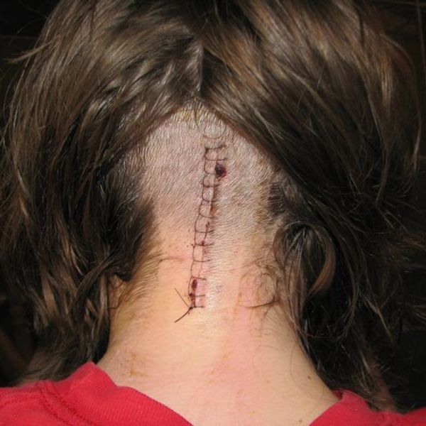 Living With Chiari Malformation: Part IV