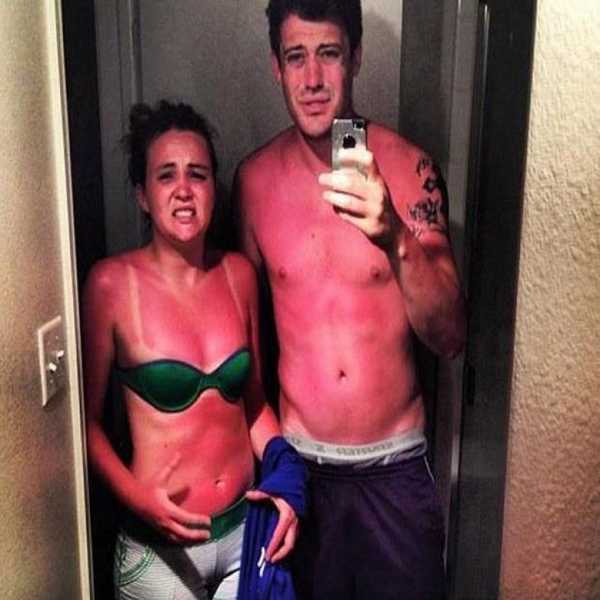 5 Stages Of The Season's First Sunburn